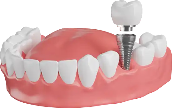 Dental Implants